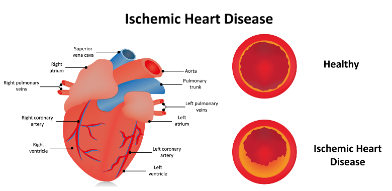 Coronary Heart Disease • TissuPath